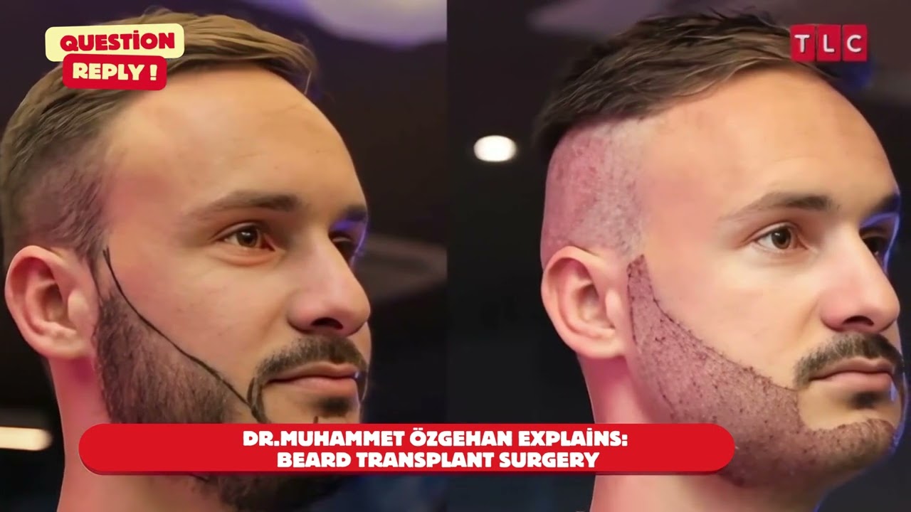 Beard Transplant