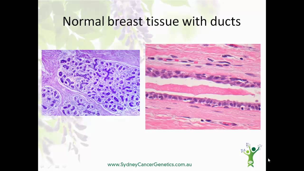 Sydney Cancer Genetics explains the Breast Cancer Pathology Report