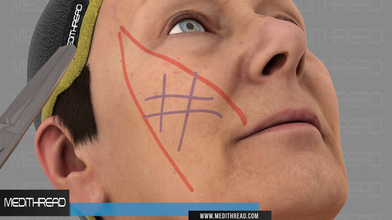 PDO THREAD LIFT TUTORIALS BY MEDITHREAD - 3D CHEEK