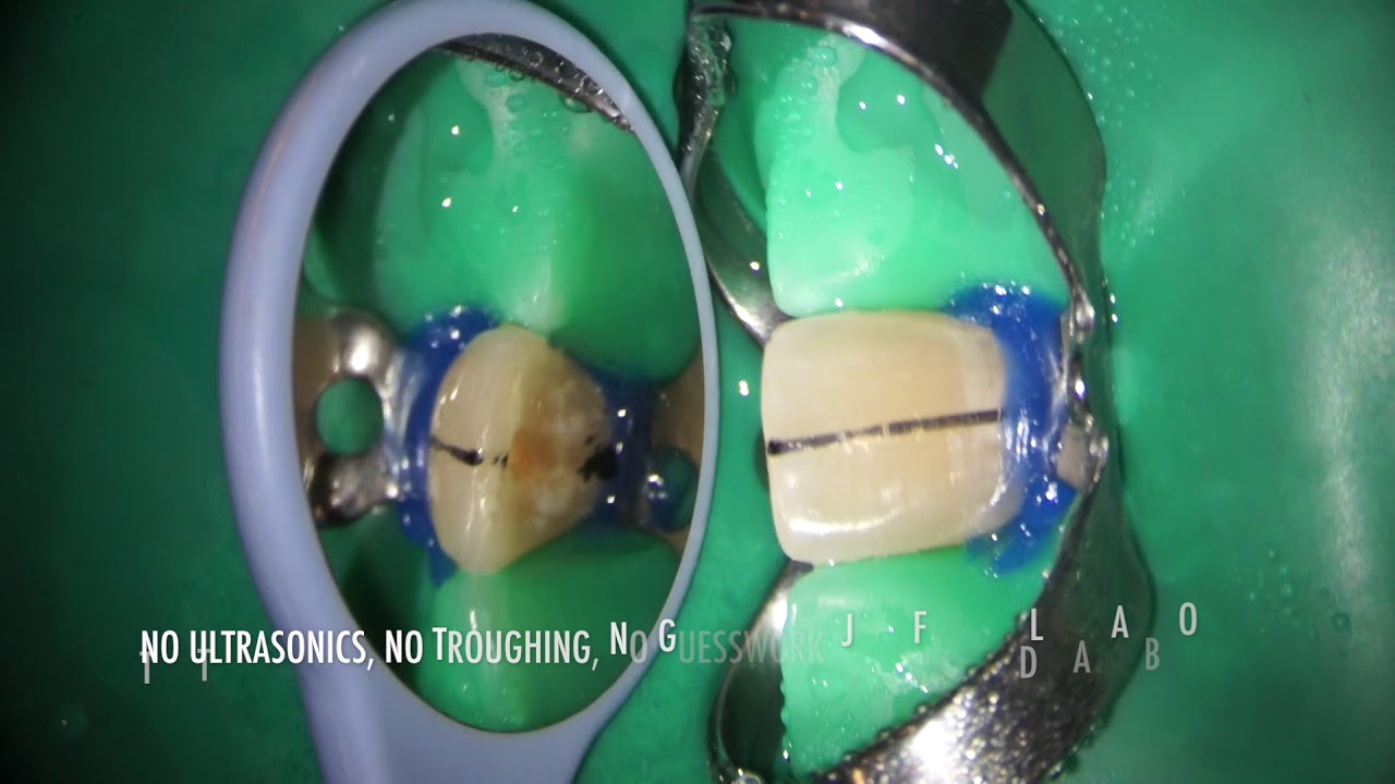 SIMPLE TECHNIQUE FOR CALCIFIED CENTRAL INCISOR MANAGEMENT