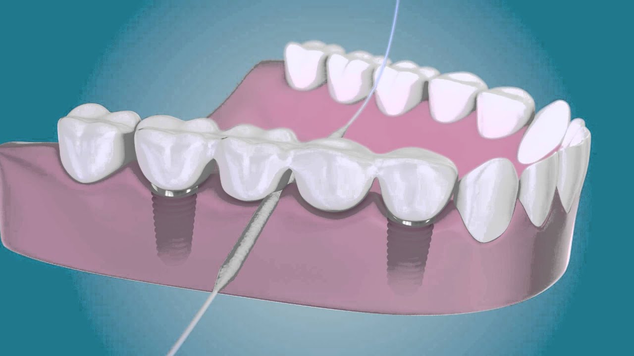 Nettoyez autour de vos implants dentaires avec TePe Bridge & Implant Floss
