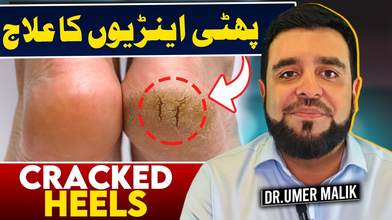 Dry Cracked Heels? Try These Remedies at Home! - Phati Ariyan Ka Asaan Ilaj