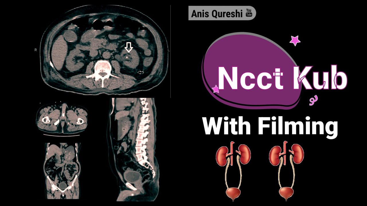 Ncct Kub with Filming| By Anis Qureshi