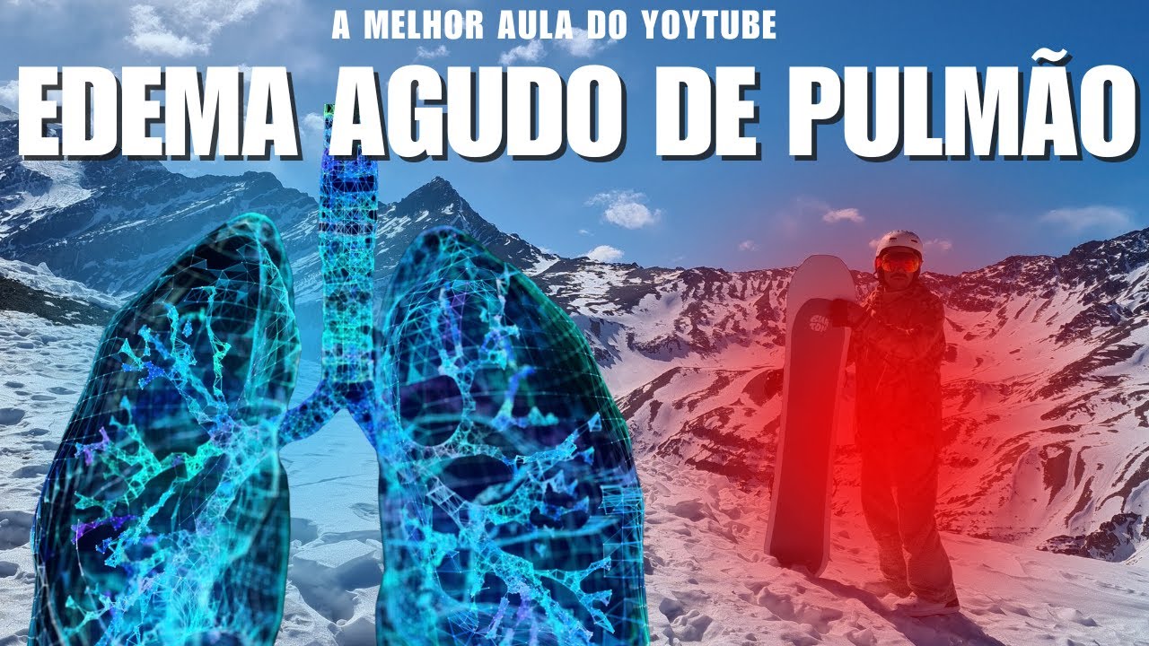 Edema Agudo de Pulmão - A melhor aula do Youtube