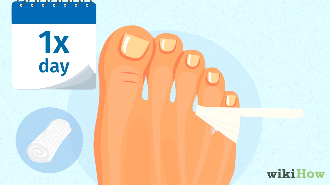 How to Tape a Broken Pinky Toe