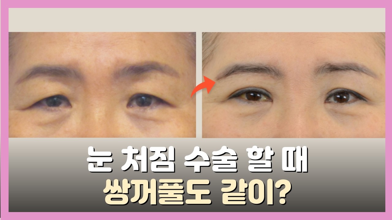 눈썹하거상만으로는 부족한가요? 매몰 쌍꺼풀을 같이 하면 좋은 경우