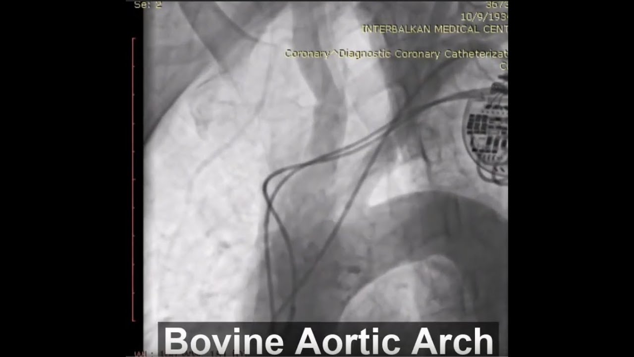 A step by step TAVI using Portico FlexNav system