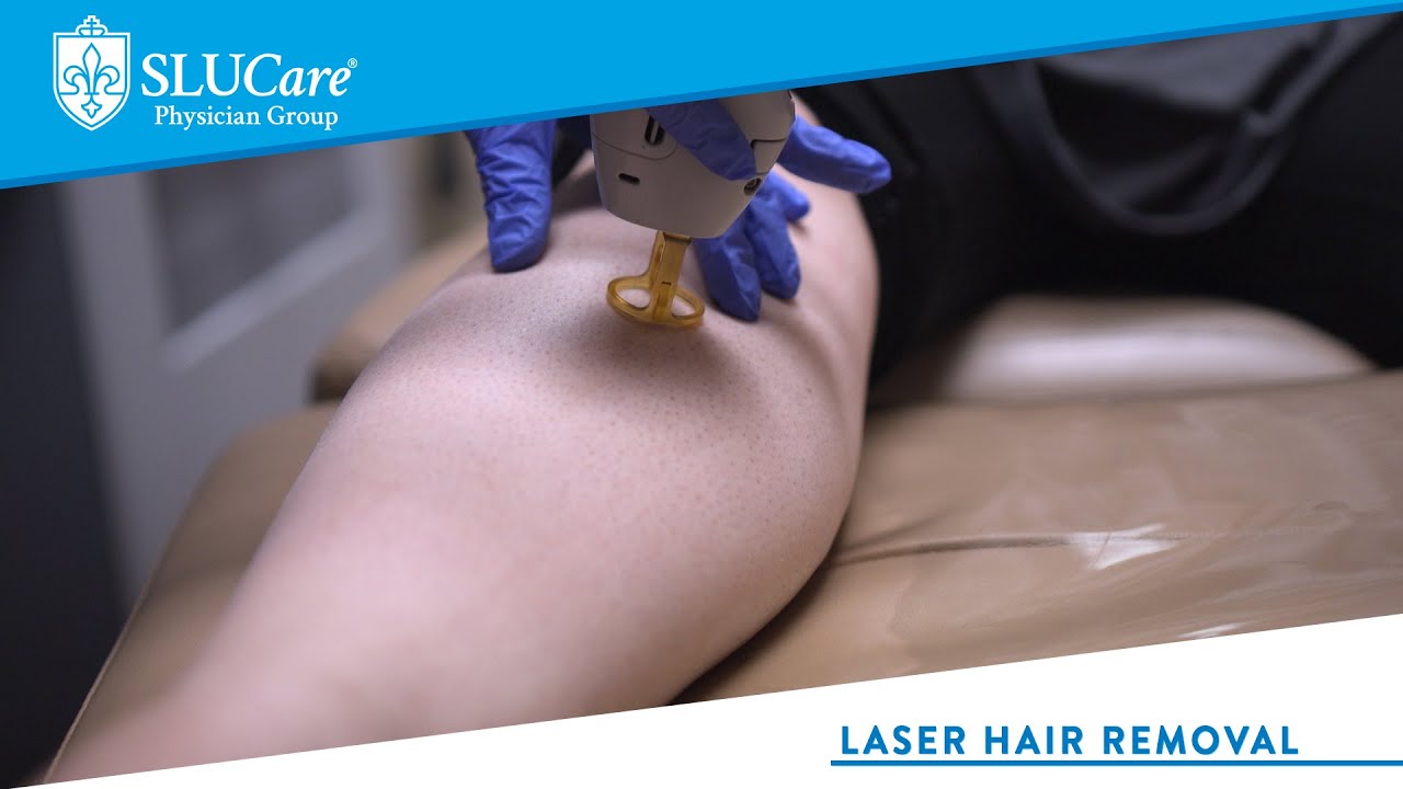 Laser Hair Removal at SLUCare Cosmetic Dermatology & Laser Surgery