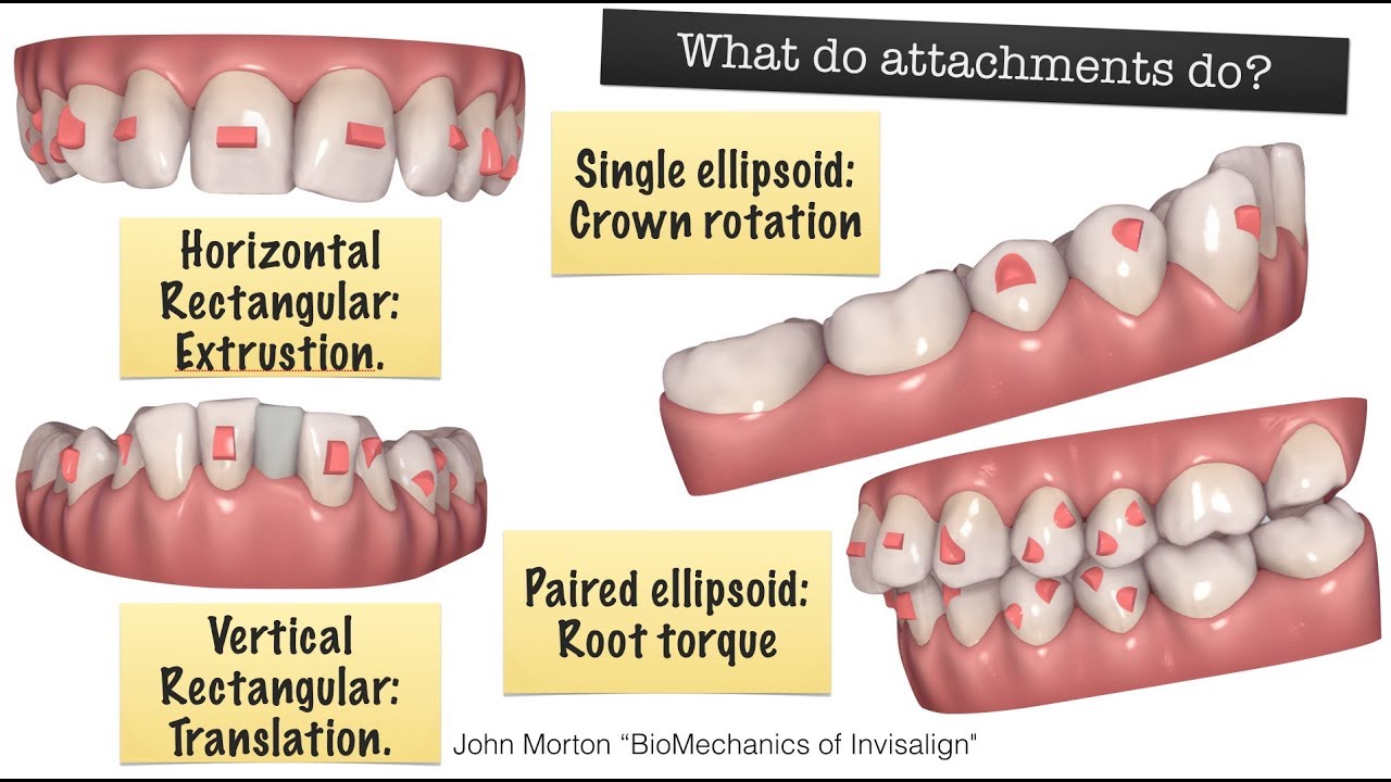3D Printing and Aligners by August de Oliveira DDS