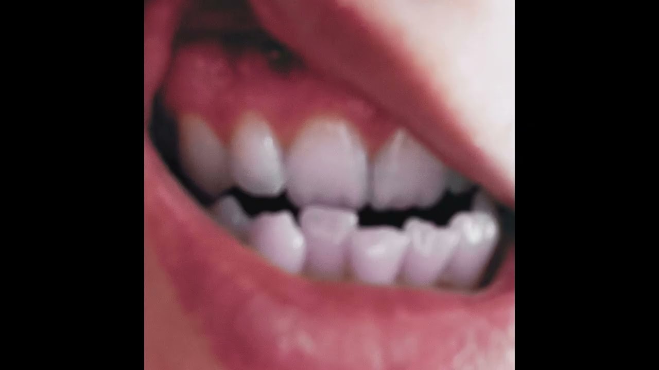 Gums