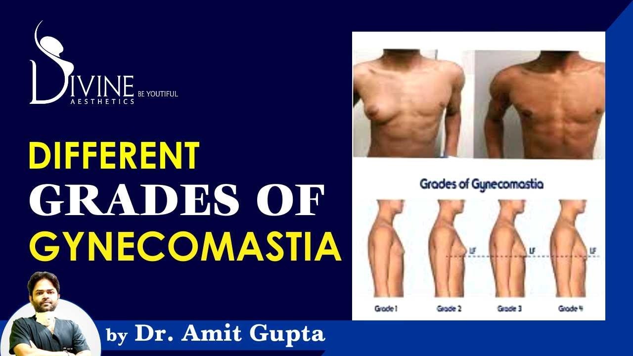 Different Grades of Gynecomastia/Man boobs/Male breast | What is Gynecomastia in Male?