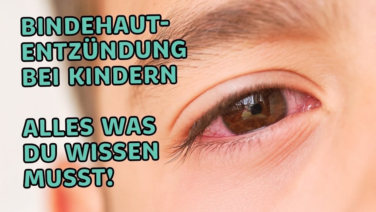 Bindehautentzündung bei Kindern – Was du wissen musst!