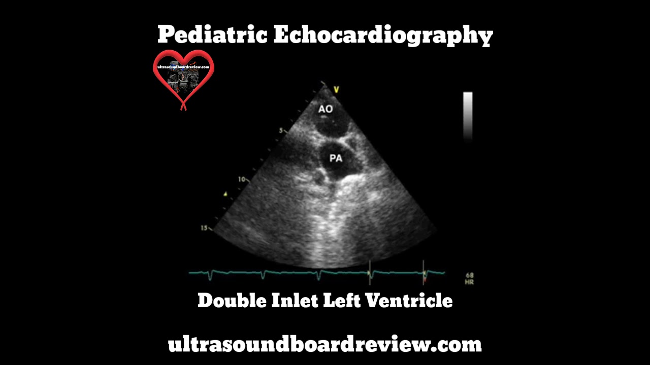 Double Inlet Left Ventricle