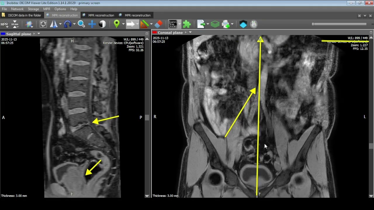 pericecal hernia парацикальная грыжа на МРТ.№ 1