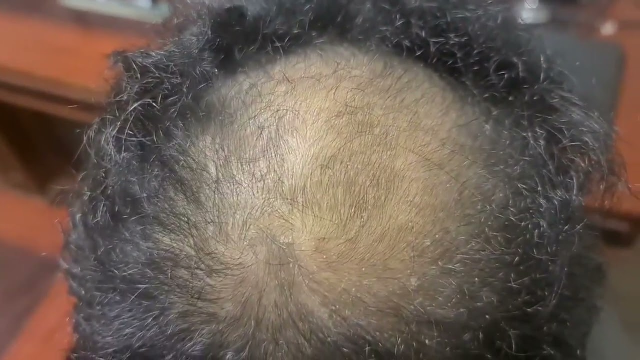 نتيجه لعمليه زراعه شعر مع دكتور محمد السيد
