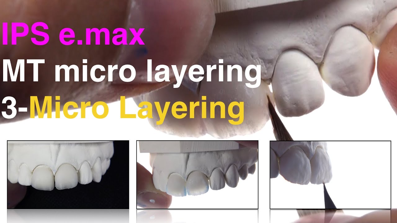IPS e max MT 3  Micro layering