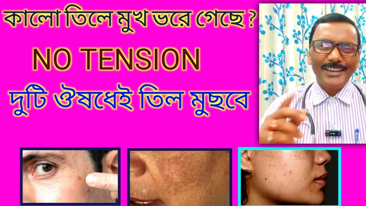 মুখে যদি কালো তিল একটি বা একাধিক থাকে তাহলে মুছবেন কি ভাবে || समाचार TRIPURA