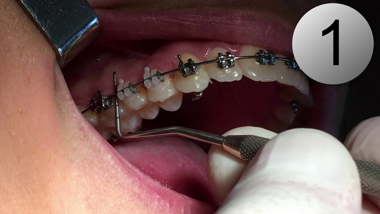 Microtornillos Ortodoncia: anclaje absoluto en 5 pasos y 5 minutos