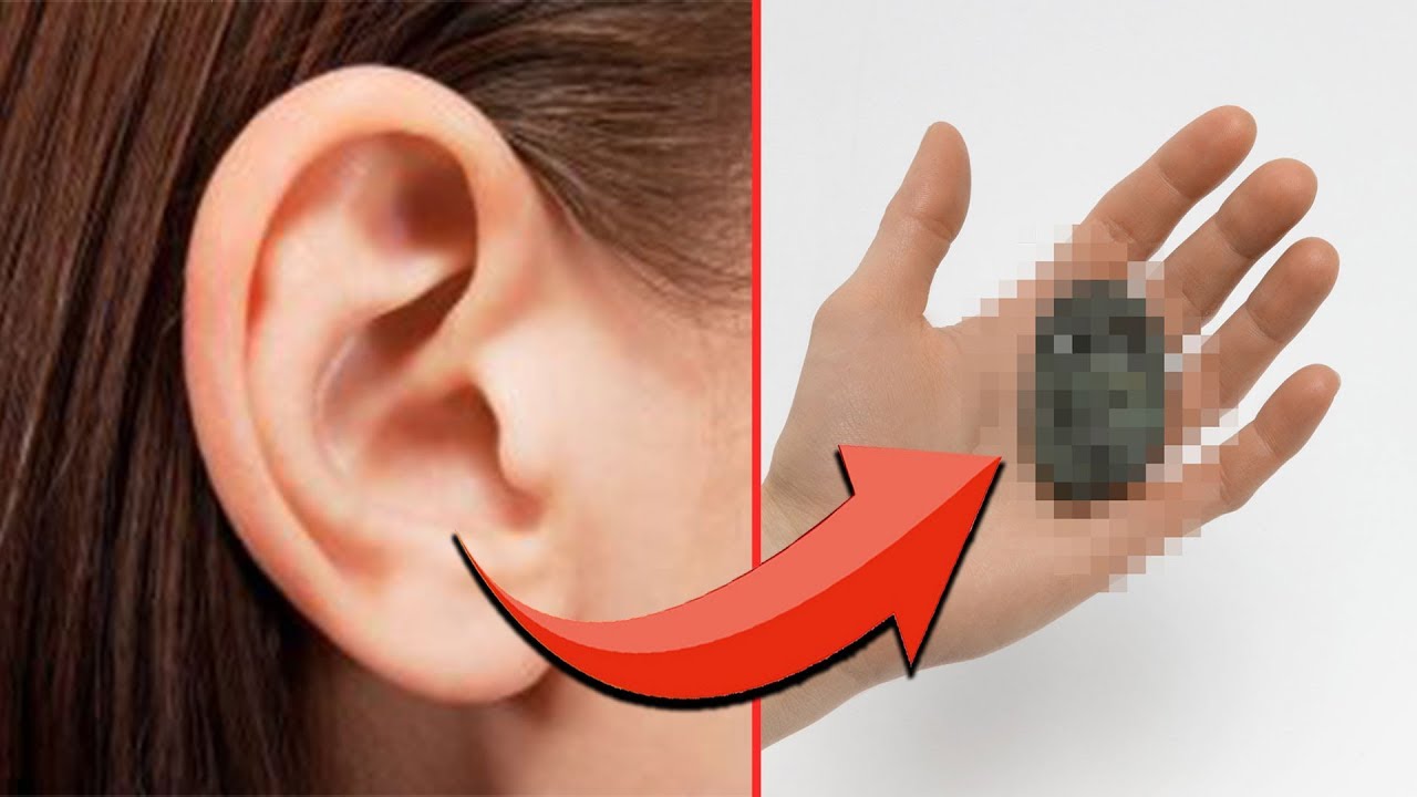 r/TIFU By Getting THIS Stuck in my Ear for 13 Years!