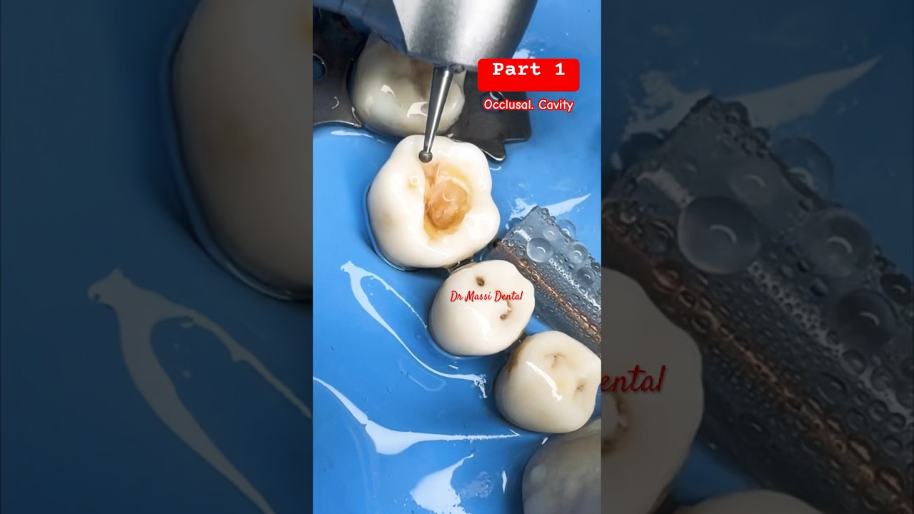 Dental Cavity preparation part 1 #cavities #vibe #viral #dentist #smile #teeth#shorts #video#viral