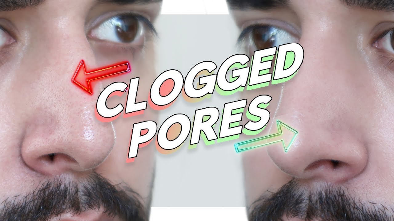 Clogged / Enlarged / Congested Pores - How To Prevent Forever! ✖  James Welsh