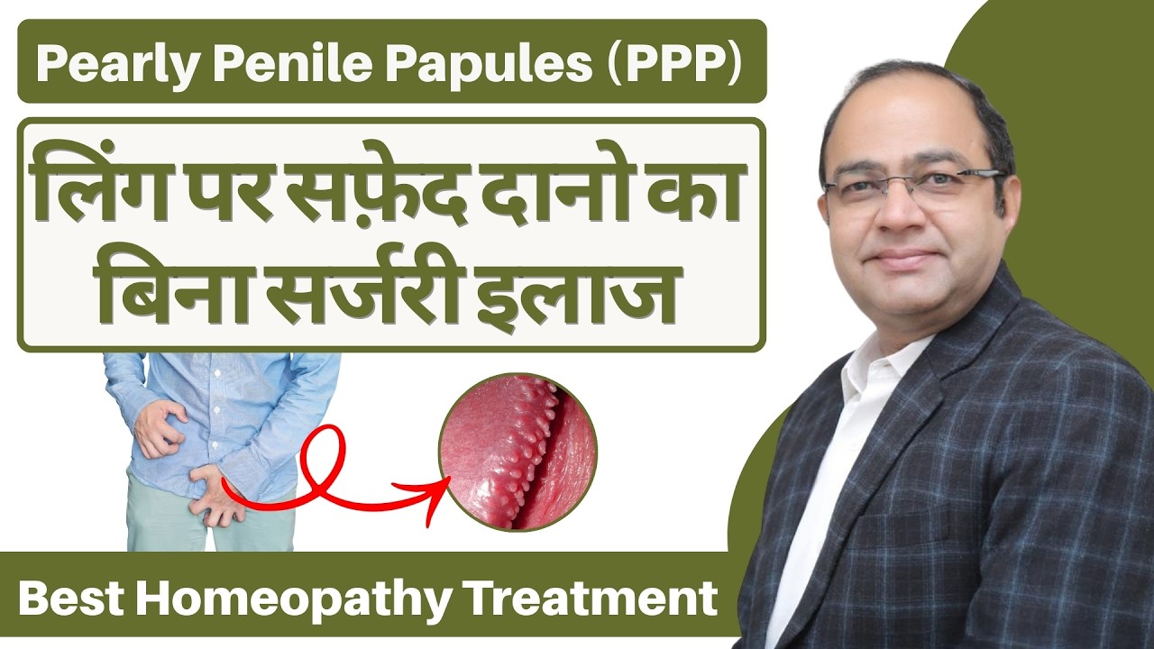 Pearly Penile Papules (PPP) Treatment | Small White Pimples on Penis &ndash; Causes, Symptoms and Homeo...