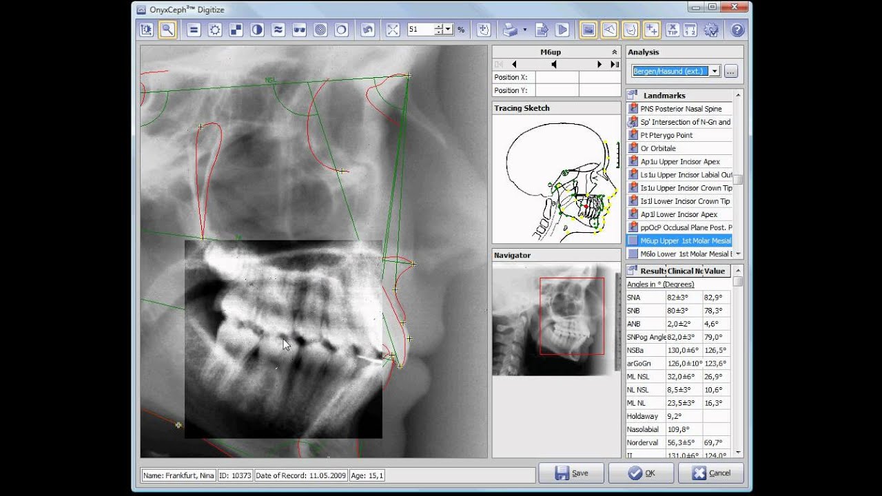 Cephalometric Analysis OnyxCeph³