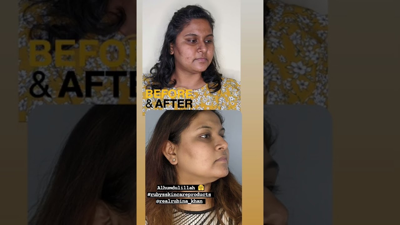 alhumdulillah before and after. Ruby's skin care products