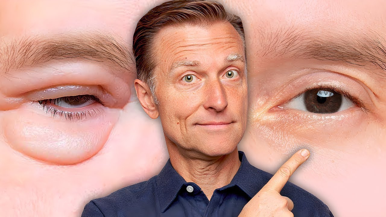 Göz Altı Torbalarından Kalıcı Olarak Nasıl Kurtulursunuz! | Dr. Berg Türkçe