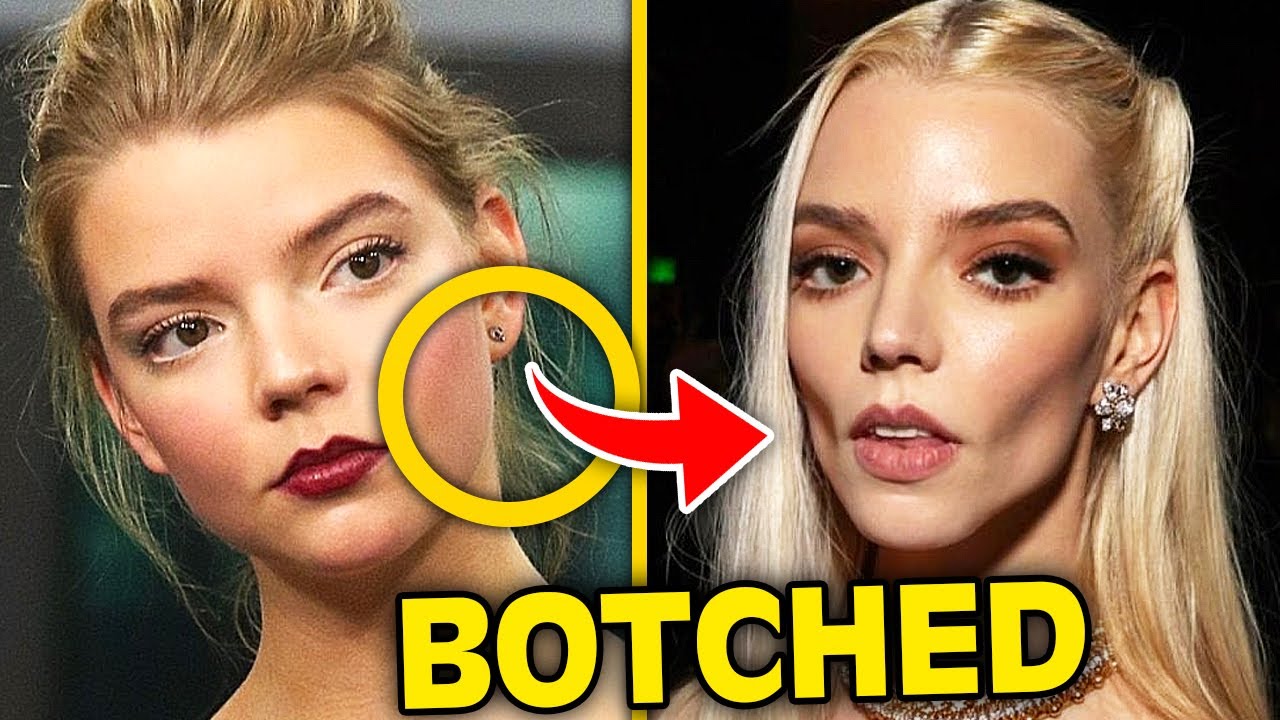 Top 10 Celebrities Who've Gotten BOTCHED From Buccal Fat Removal