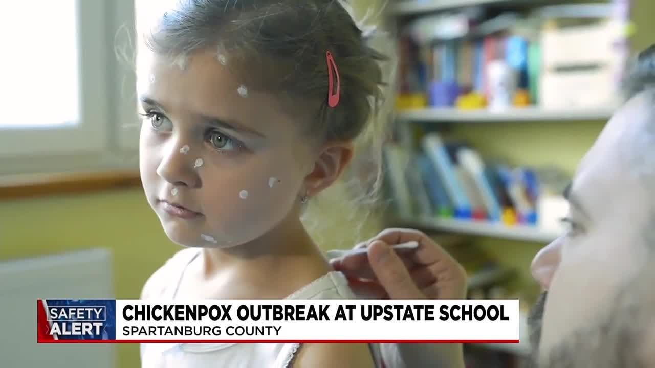 Chickenpox outbreak at upstate school