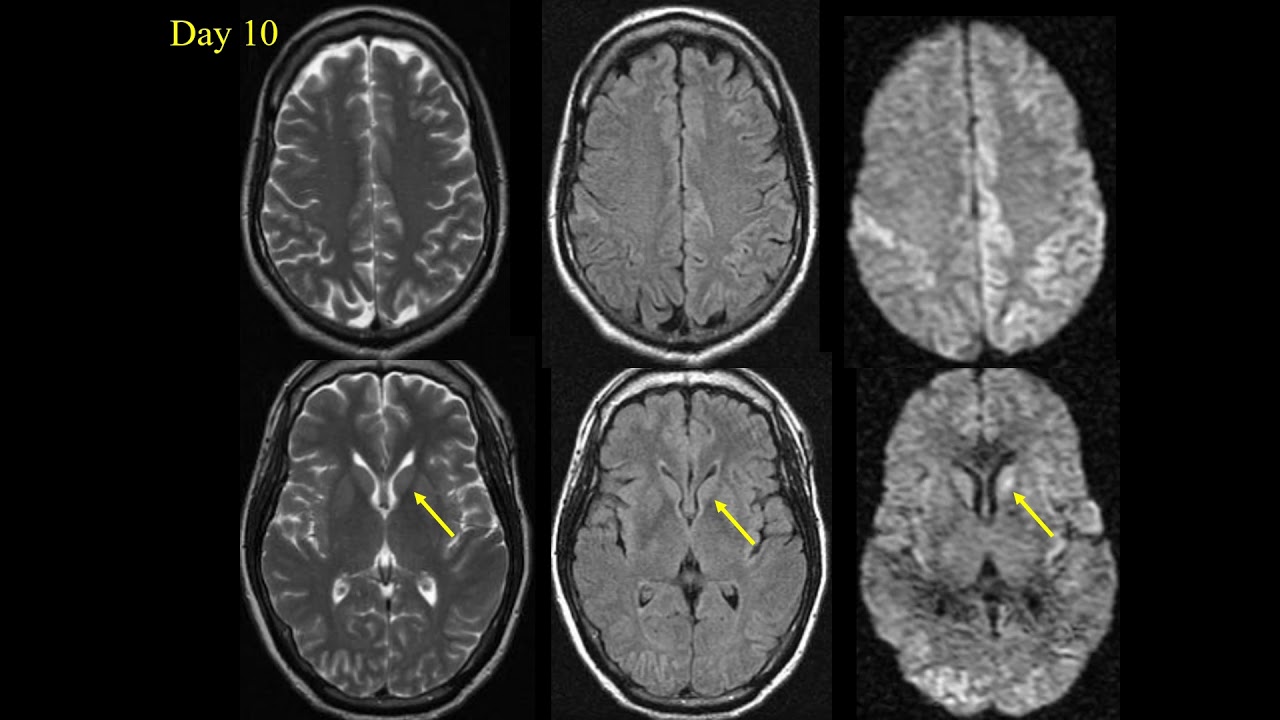 Prion Diseases   Kucharczyk   Neuroradiology Nov 2021