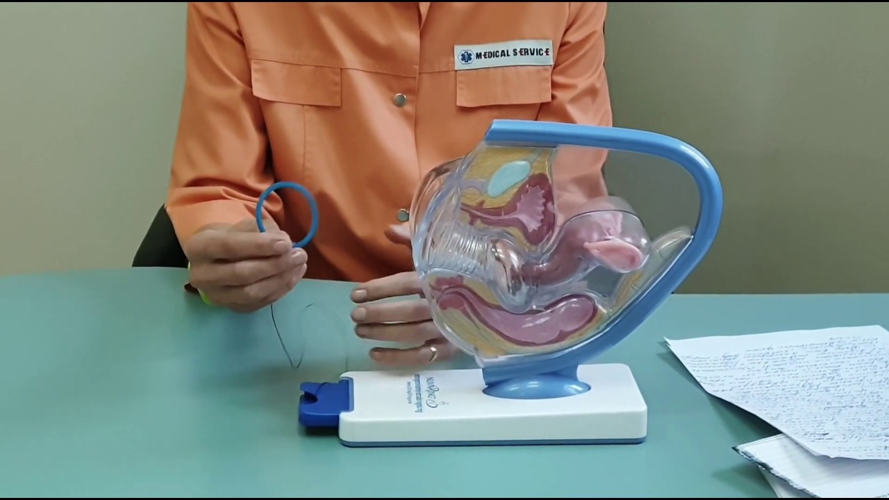 Методы контрацепции - Вагинальное кольцо | Петрикеева Ольга Викторовна гинеколог-эндокринолог