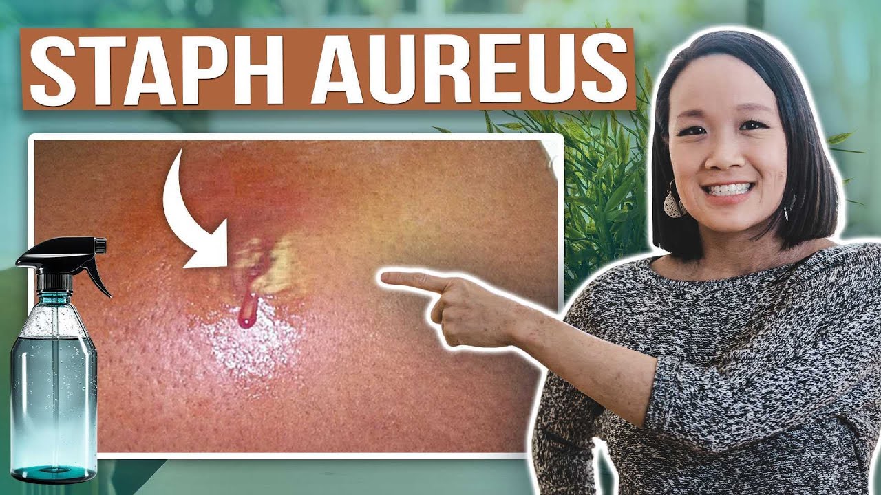 How to Deal with Staph Aureus during Eczema Outbreaks - Holistic Treatments You Need To Know