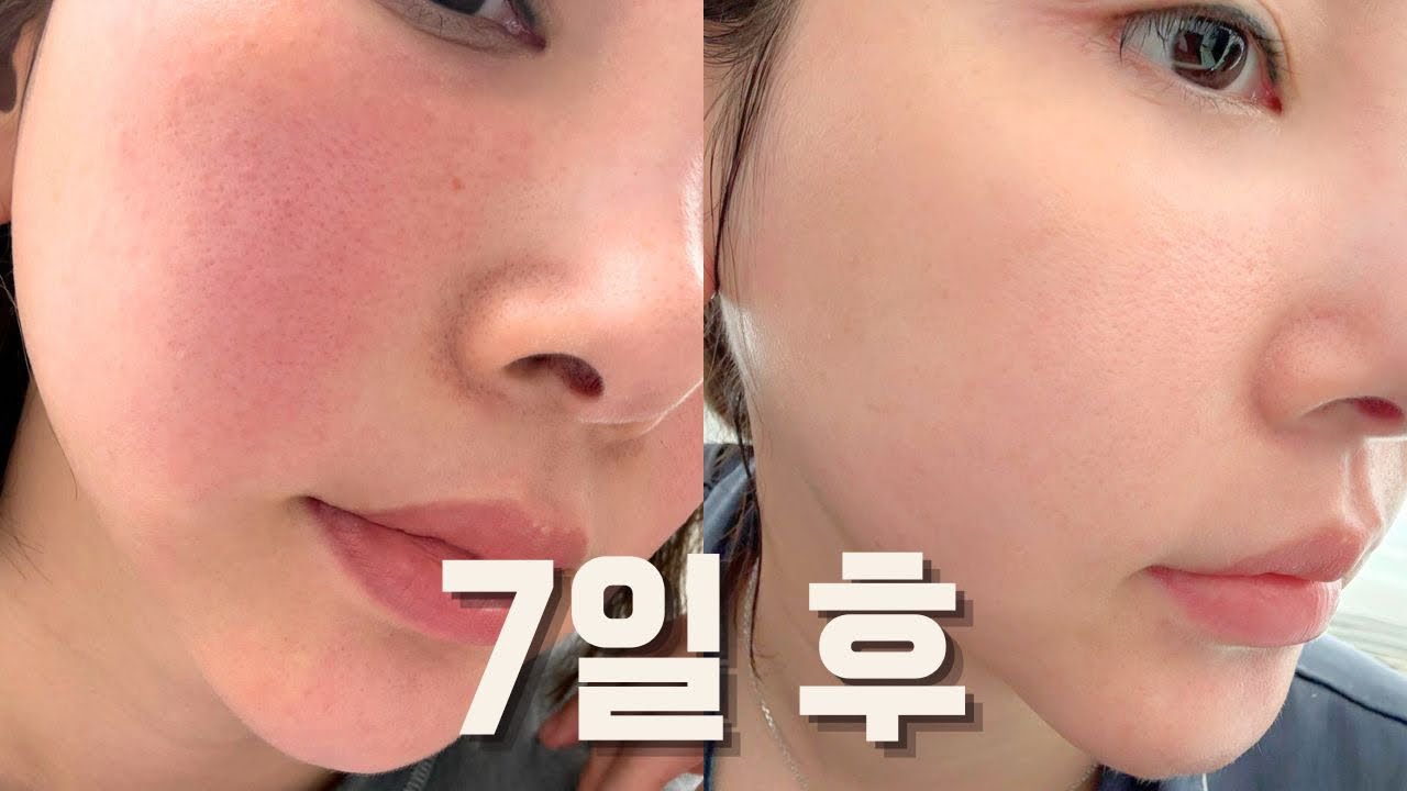 SENSITIVE AND RED SKIN! HOW TO SOLVE IT IN 1 WEEK (Skincare tips for sensitive skin)