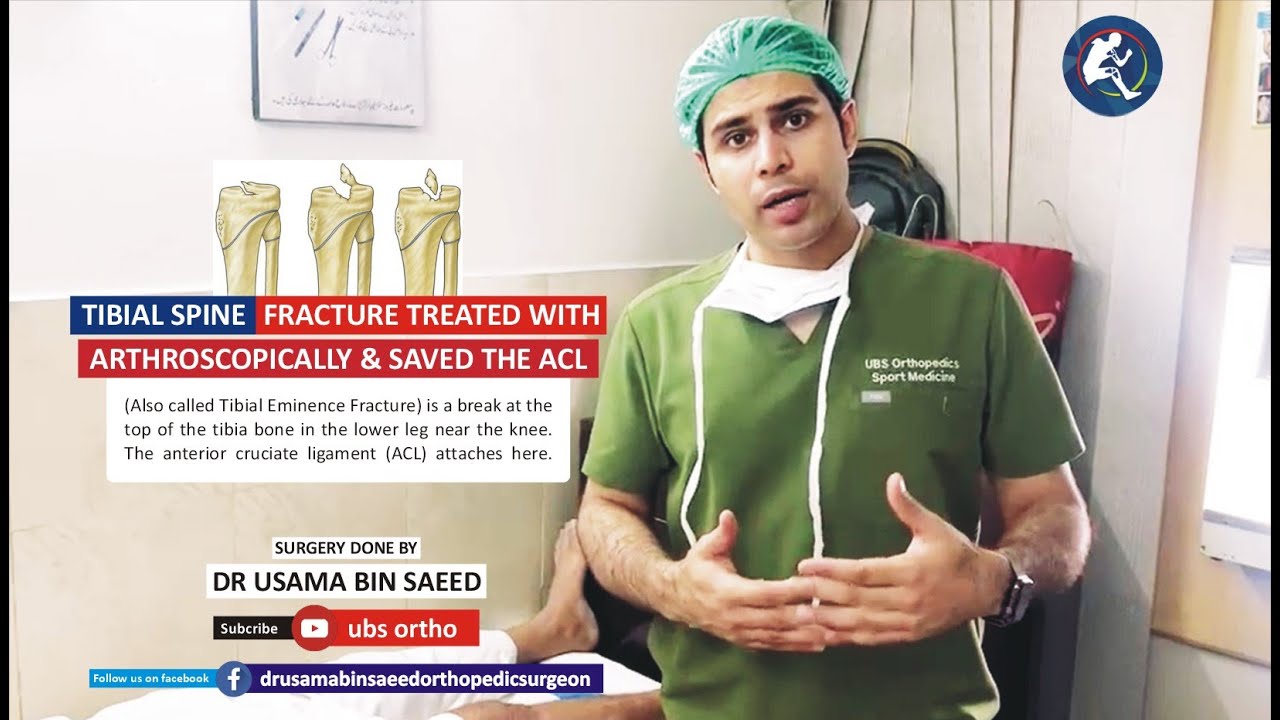 TIBIAL SPINE FRACTURE TREATED WITH ARTHROSPICALLY AND SAVED THE NATURAL ACL