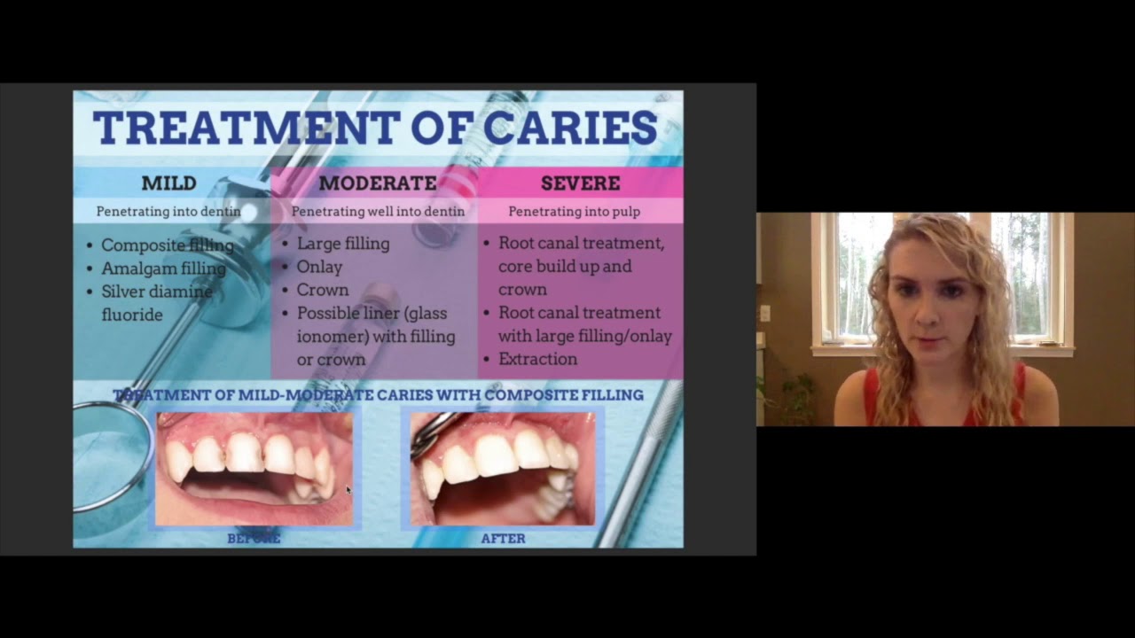 3) Oral Health Education Series: Dental Caries Part 2