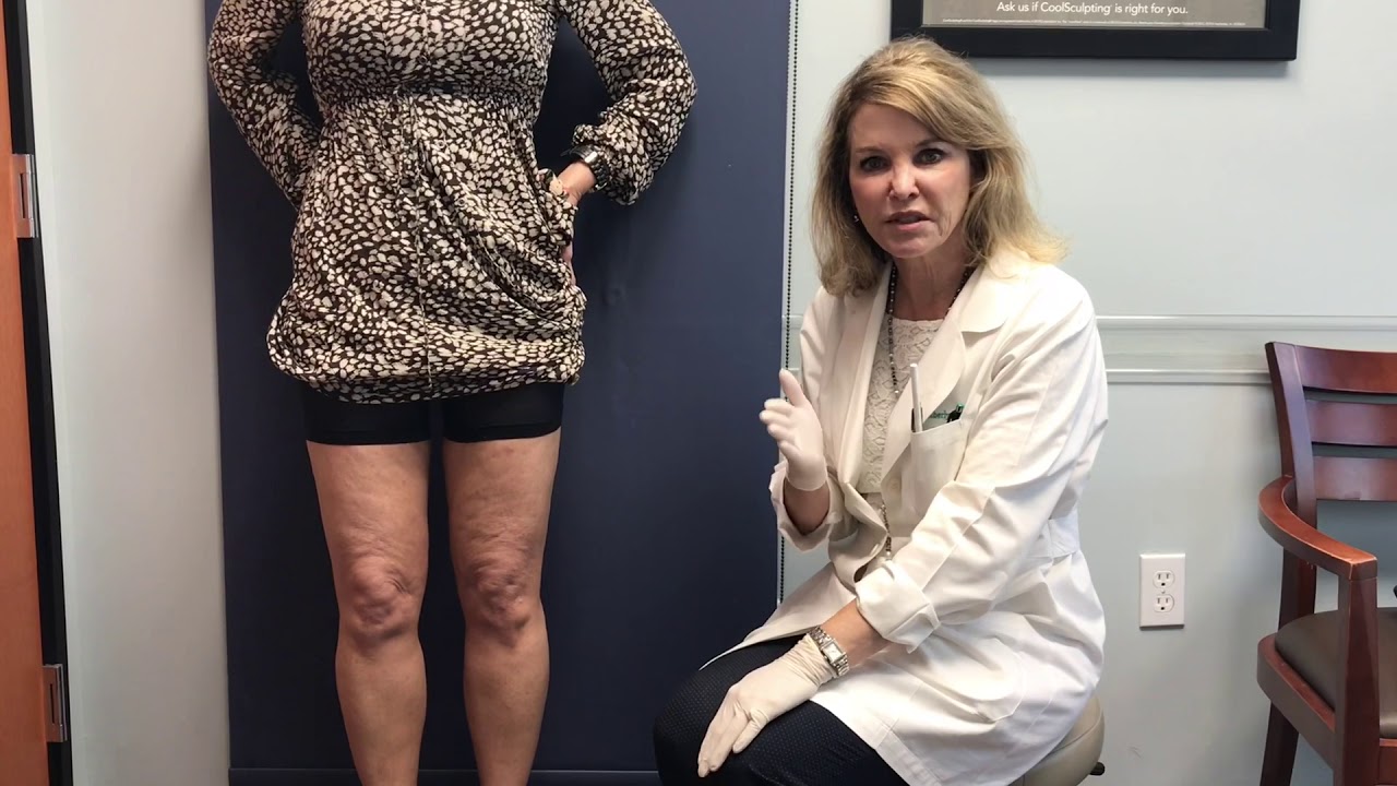 Sculptra to the Knees