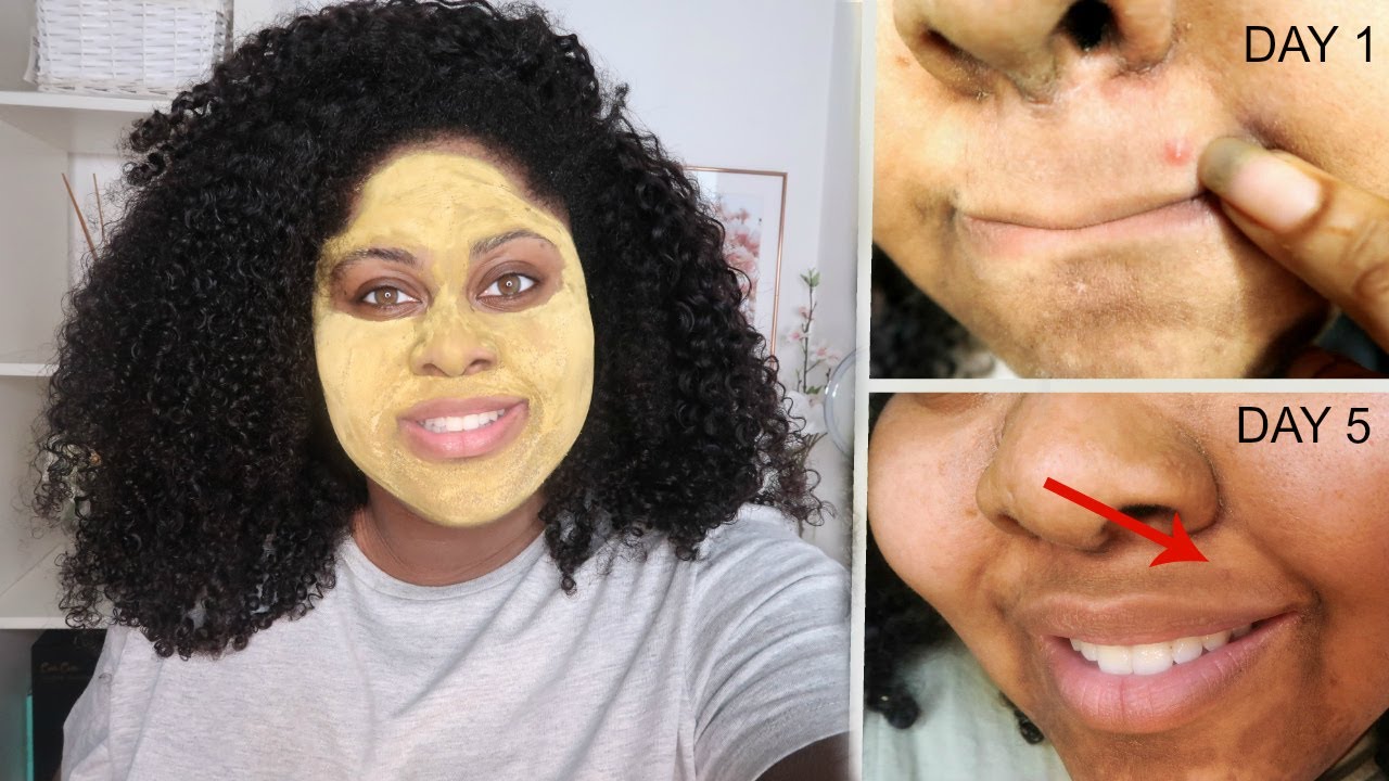 5 DAY TURMERIC AND ALOE FACE MASK (Bye Pimples!)