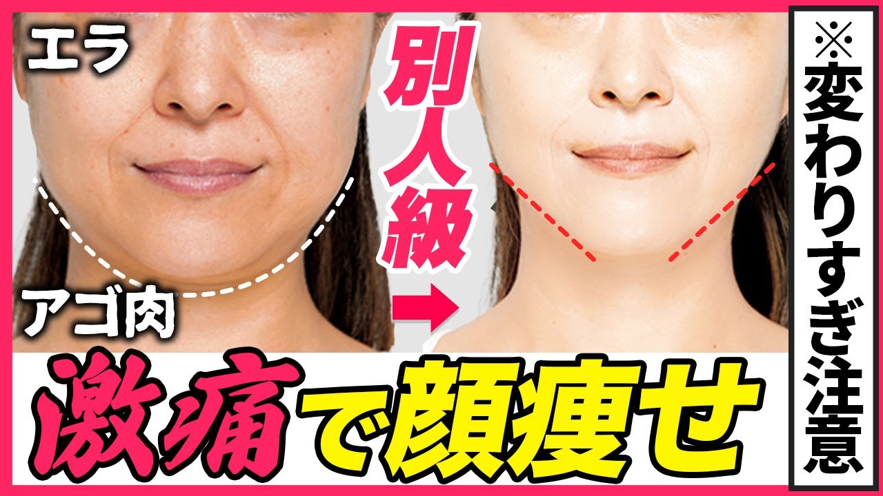 【見た目激変】顎をシャープにするたるみ・エラ取り！激痛だけど効く顔痩せ！