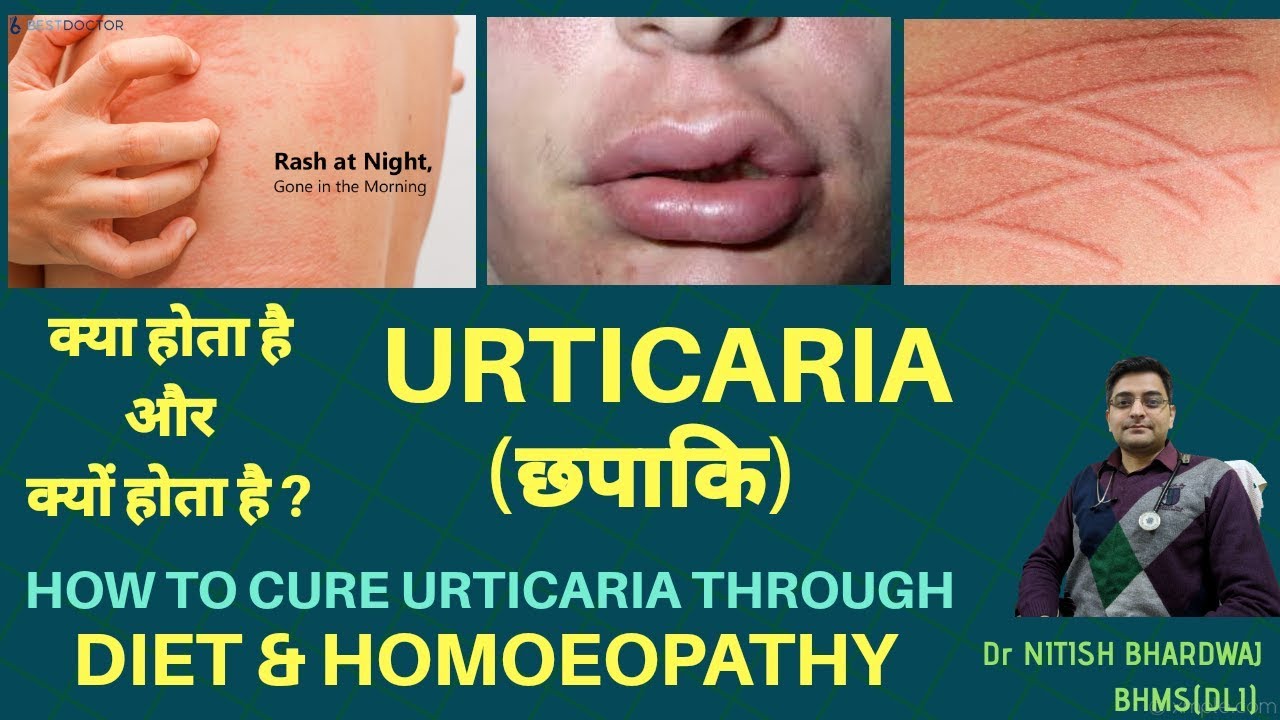 क्या है #छपाकि(#URTICARIA),कैसे करे इसे #DIET और #होमियोपैथी से ख़त्म !URTICARIA,DIET & HOMOEOPATHY