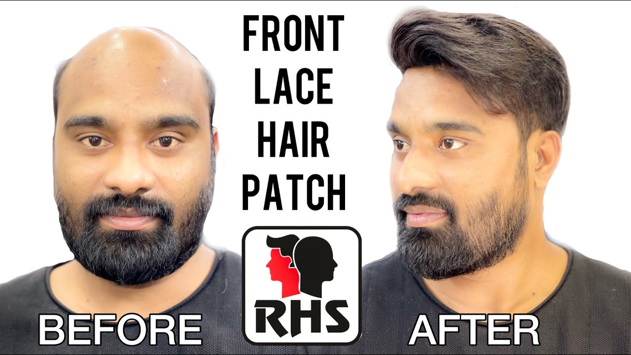 Hair Patches For Men | Front Lace Hair Patch | Natural Hairline Patch | Australian patch. 9582581323