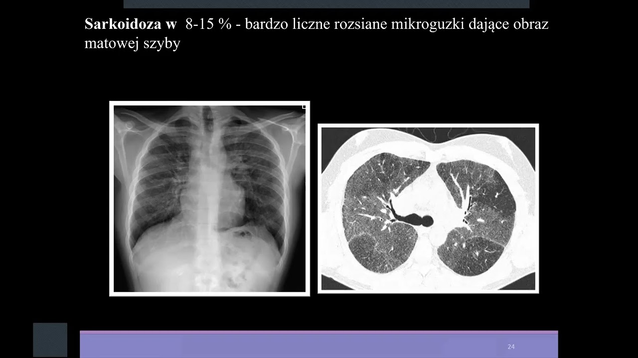 L. Opoka - Zmiany rozsiane z obecnością guzków.