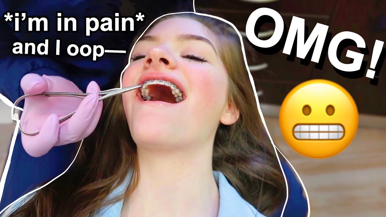 BRACES UPDATE : I GOT RUBBER BANDS !! | Lauren Hennessy