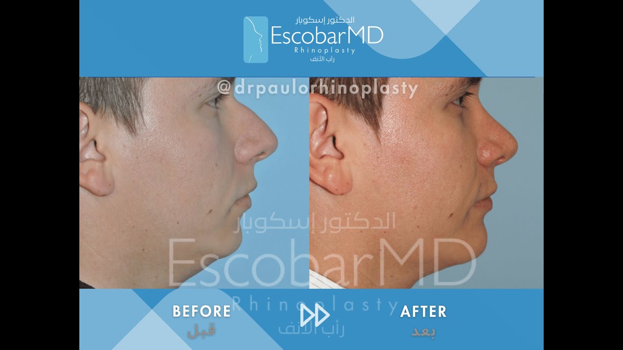 Rhinoplasty Testimonial | Closed Male Rhinoplasty with Chin Implant | Dubai