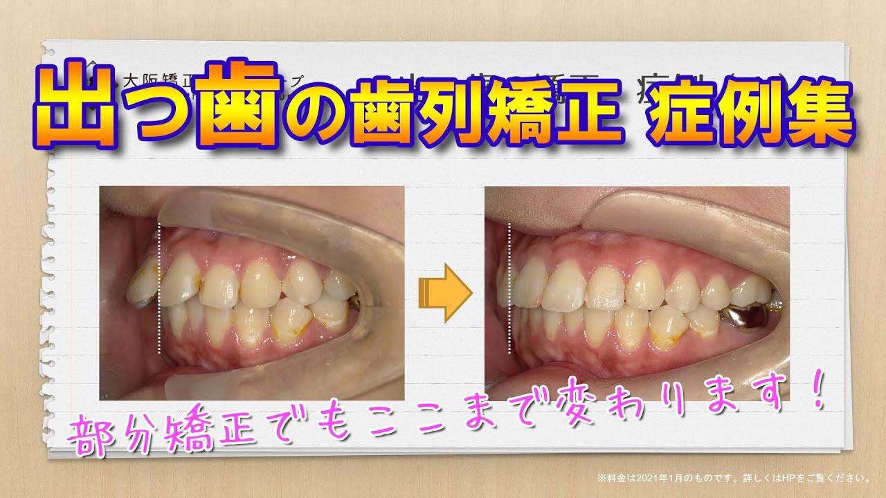出っ歯の歯列矯正症例集 ～ クローバー歯科クリニック