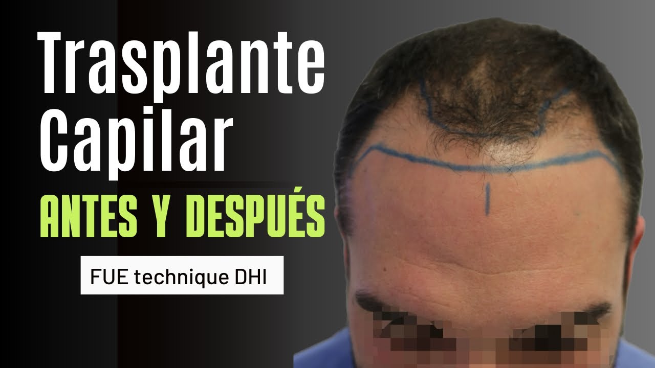 Trasplante capilar resultado | Hair transplant results | Hair transplant before after