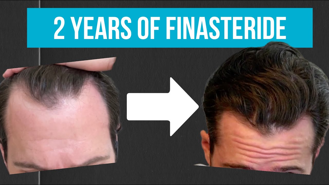 Taking Finasteride for 2yrs | Was it worth it?