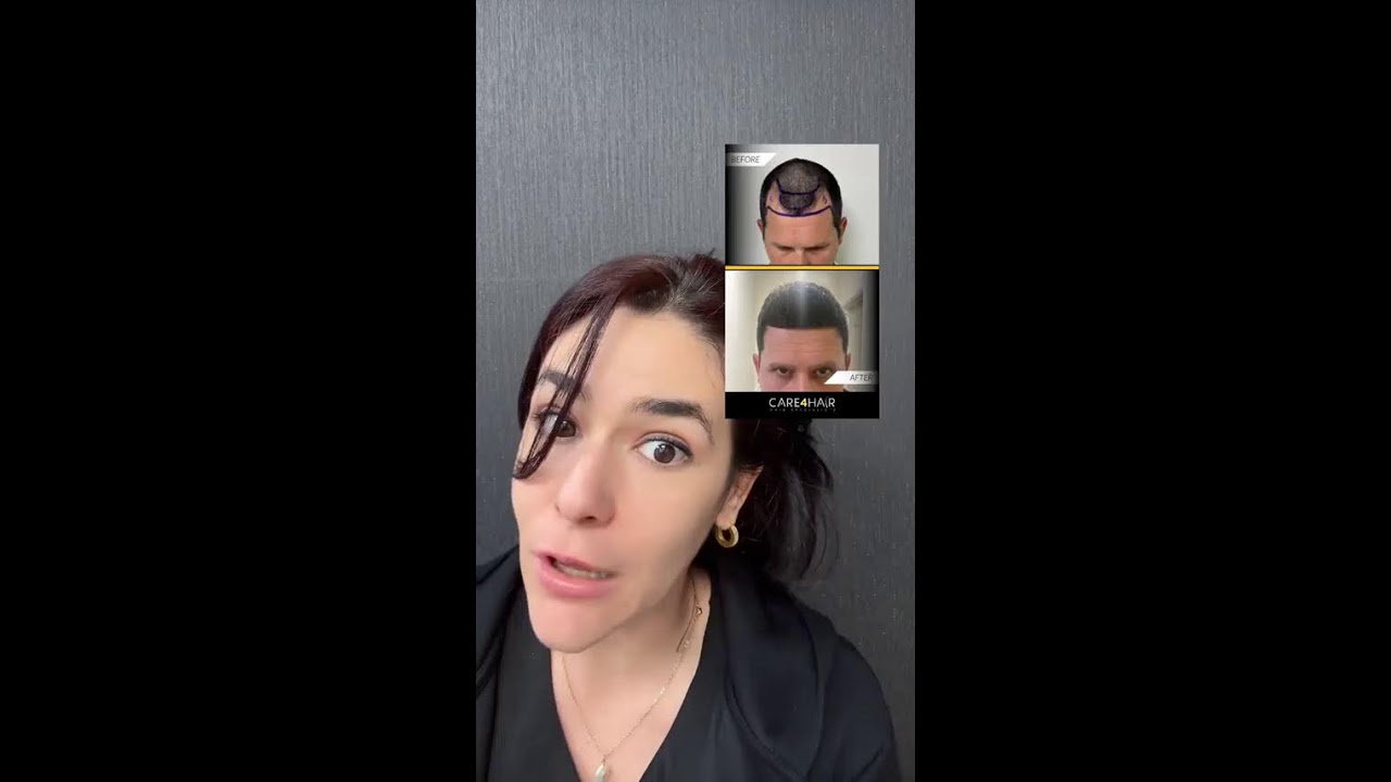 Transplante Capilar - CARE4HAIR - Consulta Gratis