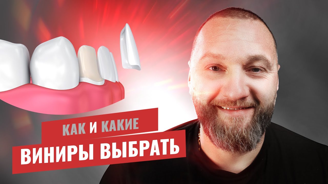 🇺🇦 Виниры - плюсы и минусы, как, и какие выбрать